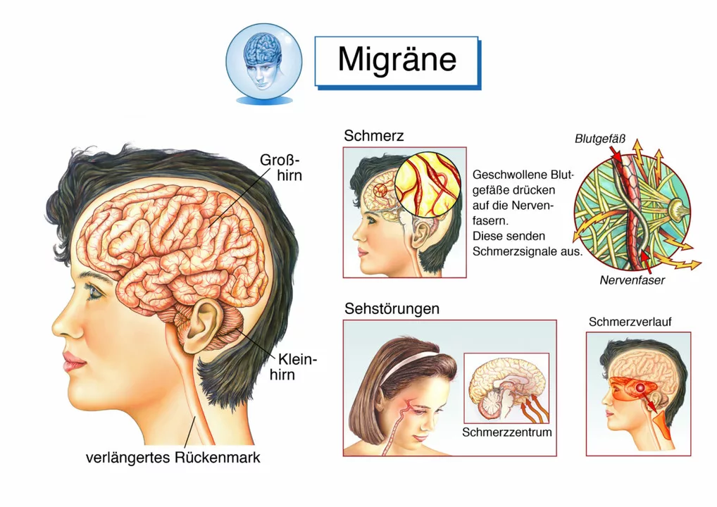 Der Zusammenhang zwischen einer laufenden Nase und Migräne: Was Sie wissen müssen